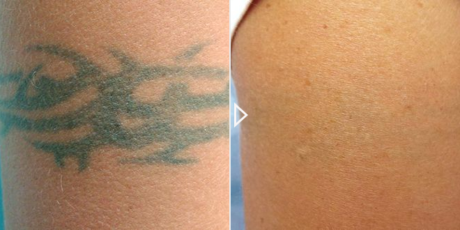 Scar-Free Tattoo Removal