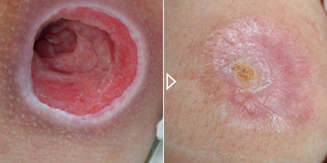 Acute & Chronic Wound Healing Acceleration