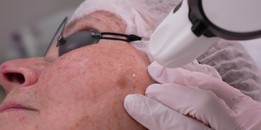 Pigmented Lesions Treatment (Pinpoint Coagulation™)